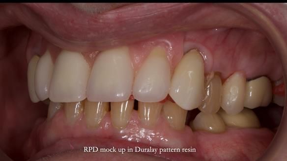 Newsletter 81 - Pam’s Story — how a partial denture changed her life (+ live walkthrough this Thursday)