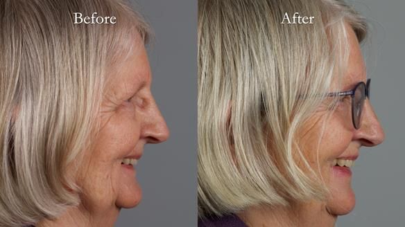 Newsletter 82 Mary - A complete upper and a one-tooth gasket denture