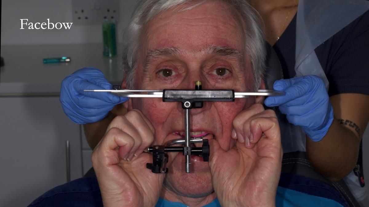 Newsletter 89 – Simon: A Challenging Kennedy Class II Division 1 Upper CoCr Partial Denture with a High Smile Line