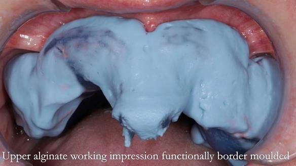 Finlay's Newsletter 58 Gasket upper partial denture for Zoe