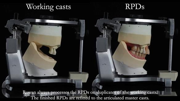 Finlay's Newsletter 59 Ultra hard partial dentures made for Gill