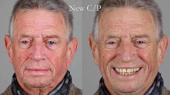 Newsletter 54 case presentation upper complete denture and lower Scandinavian designed hygienic partial denture for David