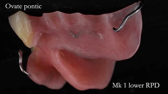 Newsletter 54 case presentation upper complete denture and lower Scandinavian designed hygienic partial denture for David