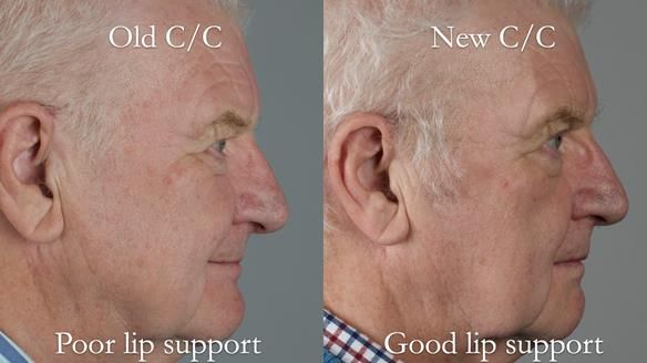 Newsletter 57 showcases the making and fitting process of implant-supported complete dentures for Alisdair