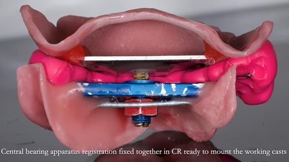Newsletter 82 Mary - A complete upper and a one-tooth gasket denture