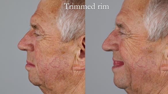 Newsletter 54 case presentation upper complete denture and lower Scandinavian designed hygienic partial denture for David