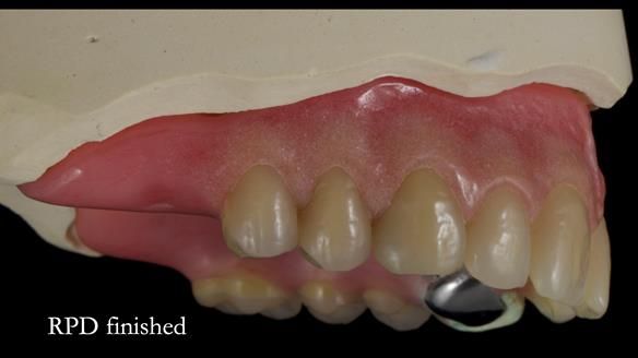 Newsletter 55 Provision of metal based partial dentures for Zephyrine with a repaired cleft lip and palate