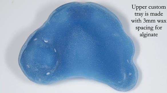 Finlay's Newsletter 58 Gasket upper partial denture for Zoe