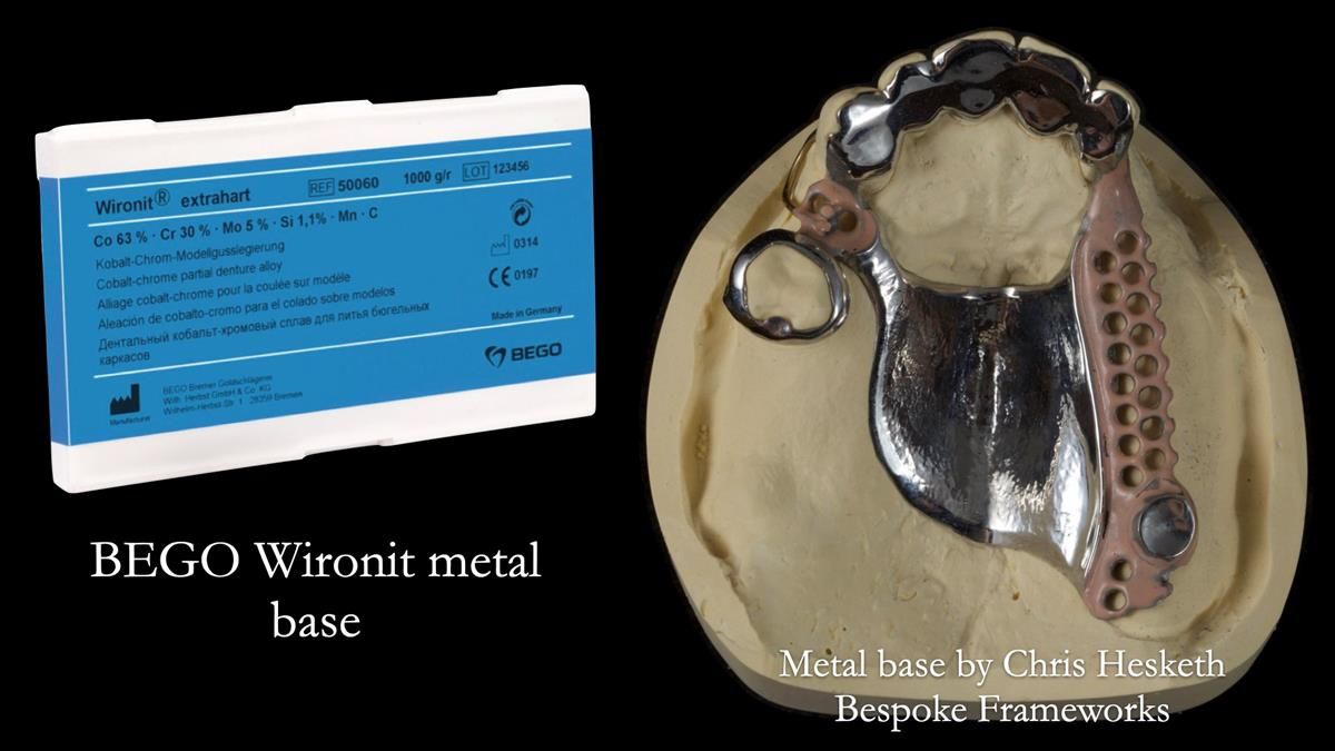 Newsletter 89 – Simon: A Challenging Kennedy Class II Division 1 Upper CoCr Partial Denture with a High Smile Line