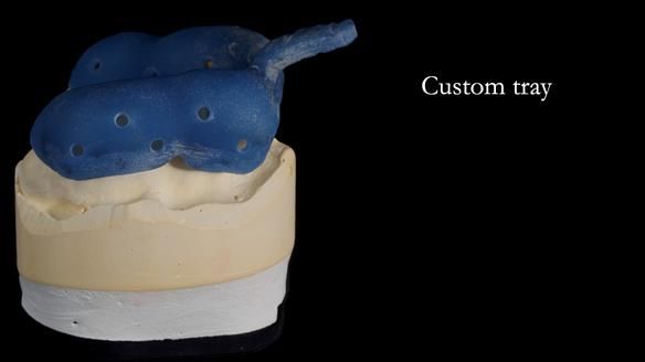 Newsletter 81 - Pam’s Story — how a partial denture changed her life (+ live walkthrough this Thursday)