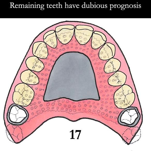 Universal Scandinavian partial denture designs