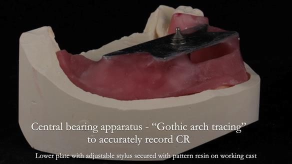 Finlay's Newsletter 59 Ultra hard partial dentures made for Gill