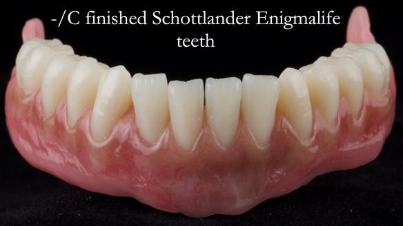 Managing poor implant positioning with complete dentures and Locator attachments - full protocol Newsletter 41