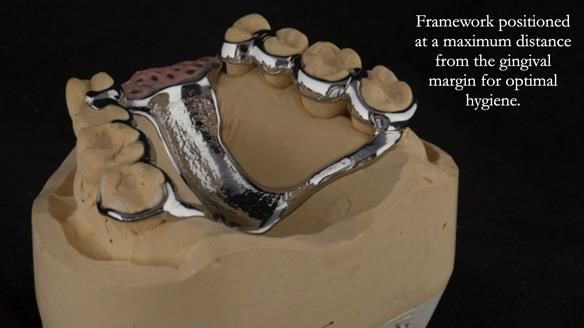 Finlay's Newsletter 63 Case study provision of metal based Scandinavian RPD - functional 10 years on
