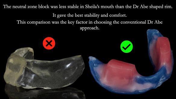 Newsletter 83: Sheila’s Complete Denture Success
