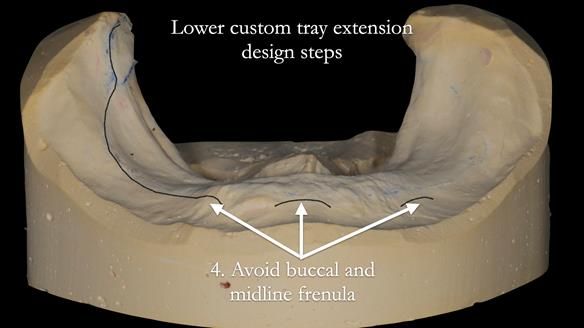Newsletter 50 Special edition Complete Dentures FULL PROTOCOL