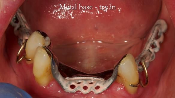Finlay's Case Study Newsletter 40 - Immediate Mk 1 RPD to Definitive Mk 2 RPD - full protocol
