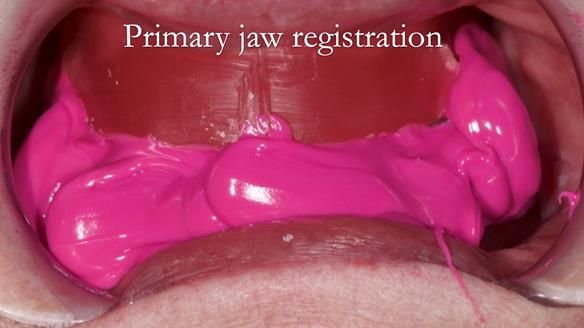 Replacing Madeline’s Complete denture FULL PROTOCOL