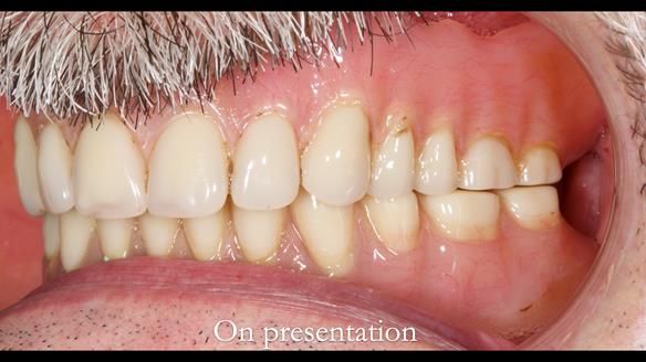 Newsletter 78: What do Clark Gable and a Locator® overdenture have in common?