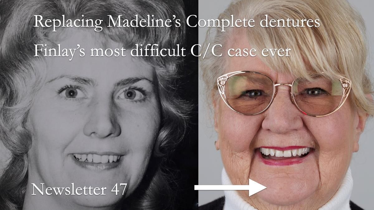 Full protocol - case presentation of Madeline's complete denture provision