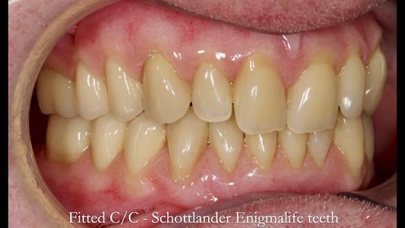 Complete denture Class II div 2 deep overbite Newsletter 39