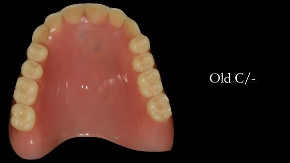 Complete denture Class II div 2 deep overbite Newsletter 39