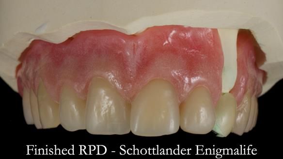 Newsletter 55 Provision of metal based partial dentures for Zephyrine with a repaired cleft lip and palate