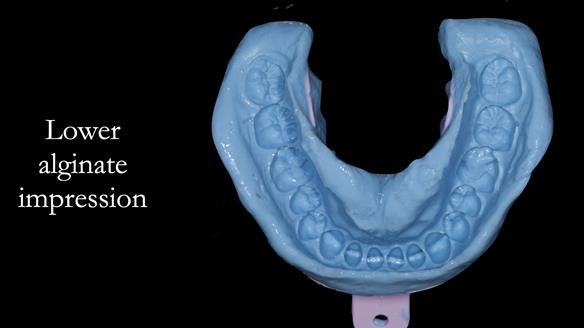 Upper metal base partial denture/occlusal stabilisation splint/obturator - full protocol