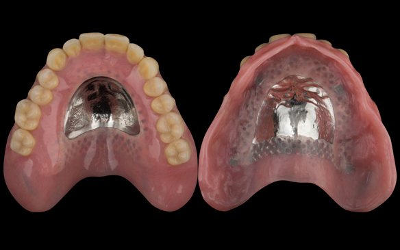 Figure 104 Mk 2 maxillary based denture with acrylic post dam which I find results in increased suction (retention) and enables relining in the future should this be needed