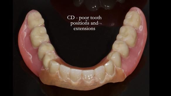 Newsletter 83: Sheila’s Complete Denture Success