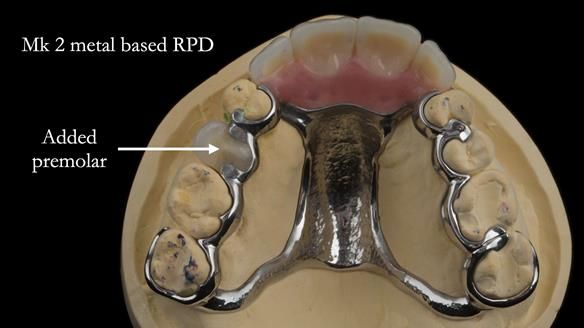 Finlay's Newsletter 63 Case study provision of metal based Scandinavian RPD - functional 10 years on
