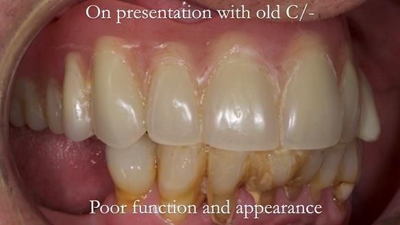 Newsletter 54 case presentation upper complete denture and lower Scandinavian designed hygienic partial denture for David