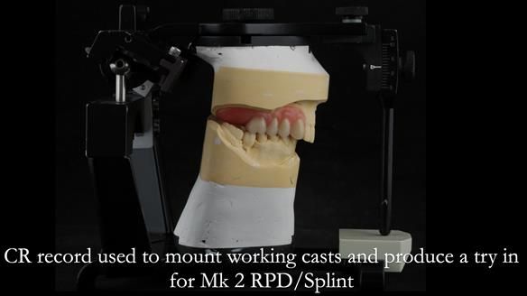 Newsletter 51 Managing Anne’s failing dentition with distal extension base RPD/Splint FULL PROTOCOL