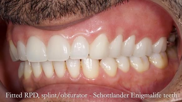 Upper metal base partial denture/occlusal stabilisation splint/obturator - full protocol