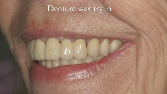 Newsletter 76: Jackie’s case – Telescopic overdenture & precision RPD (the tricky truth!)