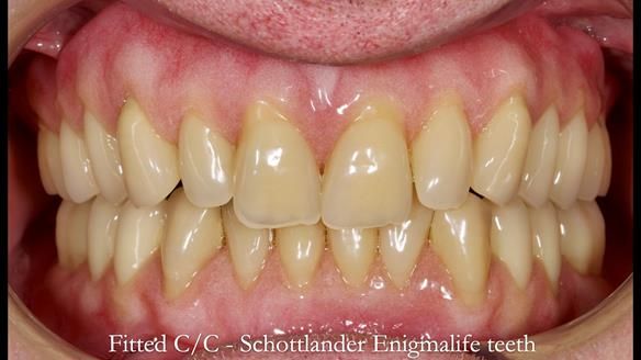 Complete denture Class II div 2 deep overbite Newsletter 39