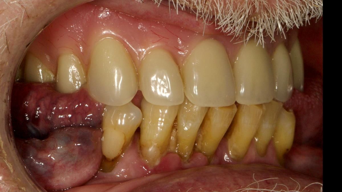 Newsletter 87 – Father Peter: A Partial Denture that needed Minor Miracle