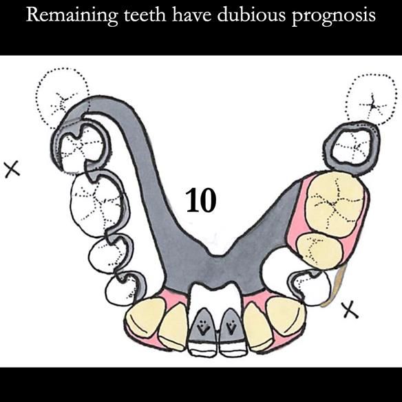 Universal Scandinavian partial denture designs