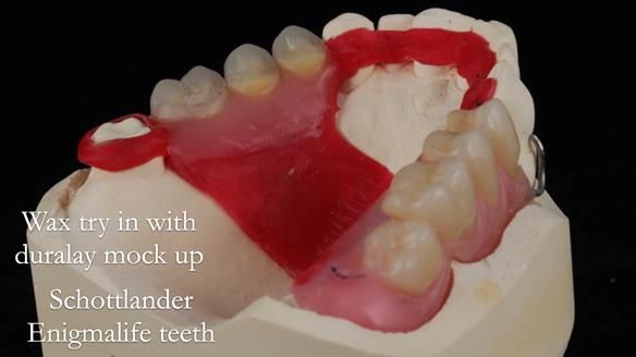 Finlay's Newsletter 60 Sylvia's upper Kennedy Class 2 Mod 1 metal based upper RPD