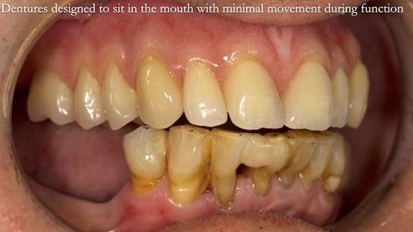 Newsletter 54 case presentation upper complete denture and lower Scandinavian designed hygienic partial denture for David