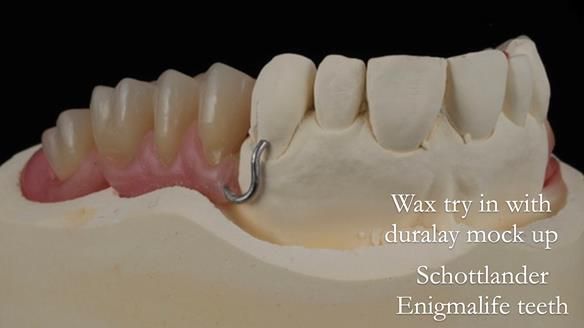 Finlay's Newsletter 60 Sylvia's upper Kennedy Class 2 Mod 1 metal based upper RPD