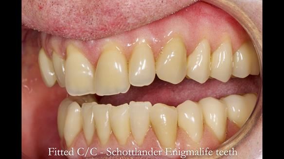 Complete denture Class II div 2 deep overbite Newsletter 39