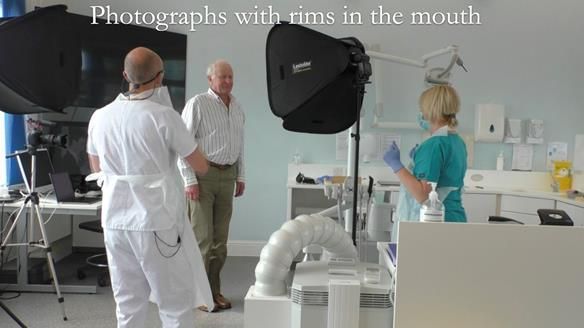 Complete denture Class II div 2 deep overbite Newsletter 39