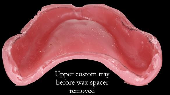 Newsletter 50 Special edition Complete Dentures FULL PROTOCOL