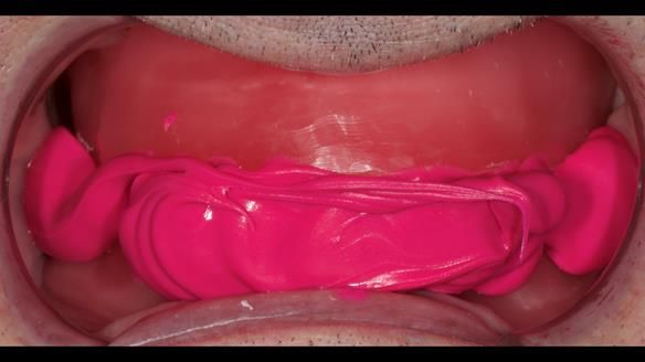 Newsletter 80 - Gordon’s dentures: the one case in 1,000 where my technique failed