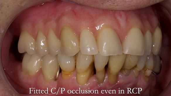 Newsletter 54 case presentation upper complete denture and lower Scandinavian designed hygienic partial denture for David