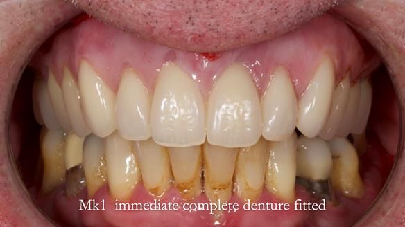 Newsletter 77: Jeremy’s case – immediate complete upper denture
