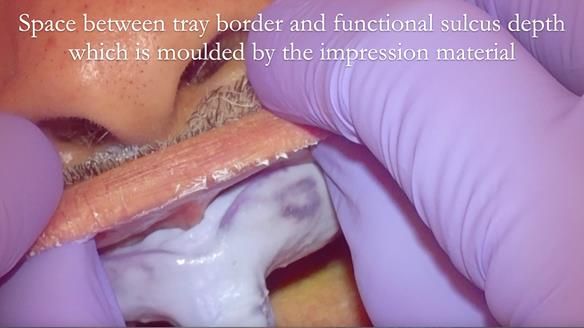 Finlay's Newsletter 62 provision of extractions and metal based complete dentures for Rafique