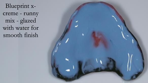 Newsletter 54 case presentation upper complete denture and lower Scandinavian designed hygienic partial denture for David
