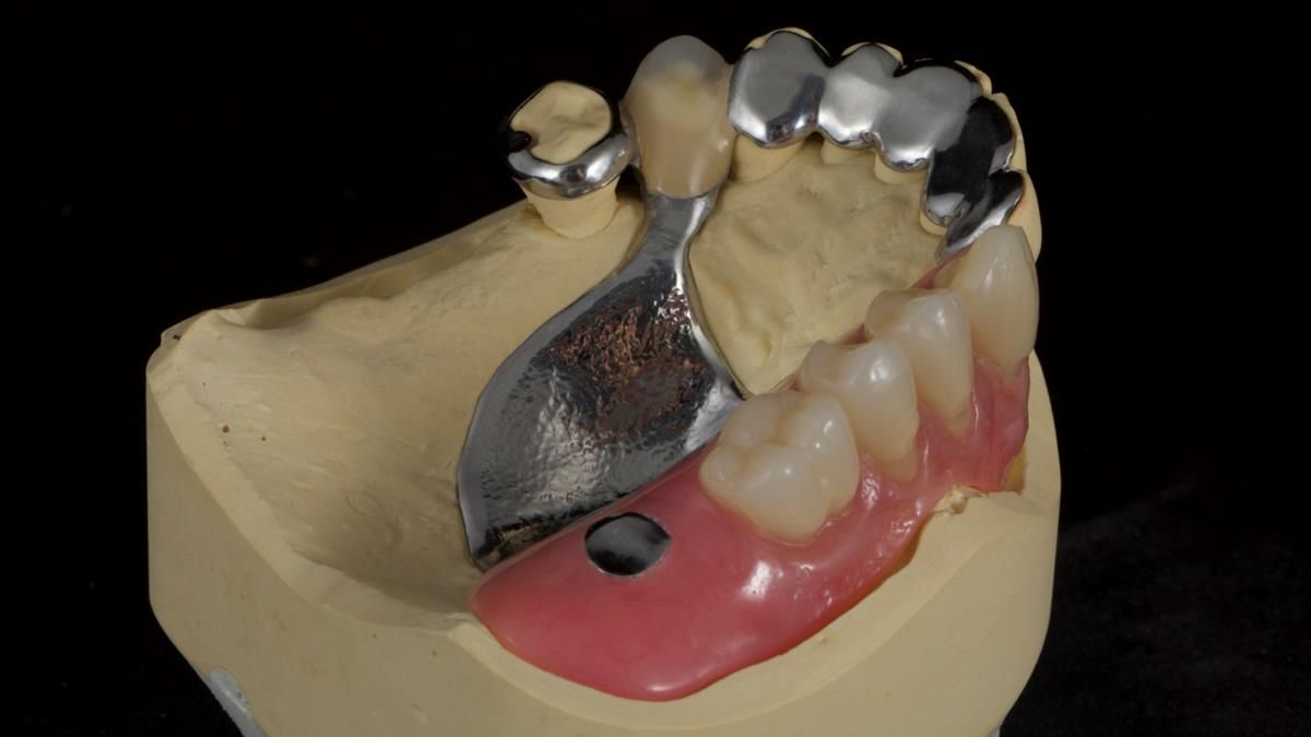 Newsletter 89 – Simon: A Challenging Kennedy Class II Division 1 Upper CoCr Partial Denture with a High Smile Line